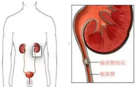 輸尿管結(jié)石，到底能不能保守治療？