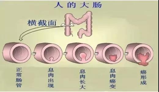 體檢發(fā)現(xiàn)腸息肉會癌變嗎？