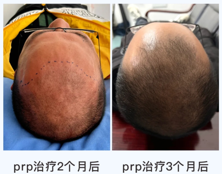 “我的頭發(fā)長(zhǎng)出來了”——自體富血小板血漿（PRP）治療脫發(fā)